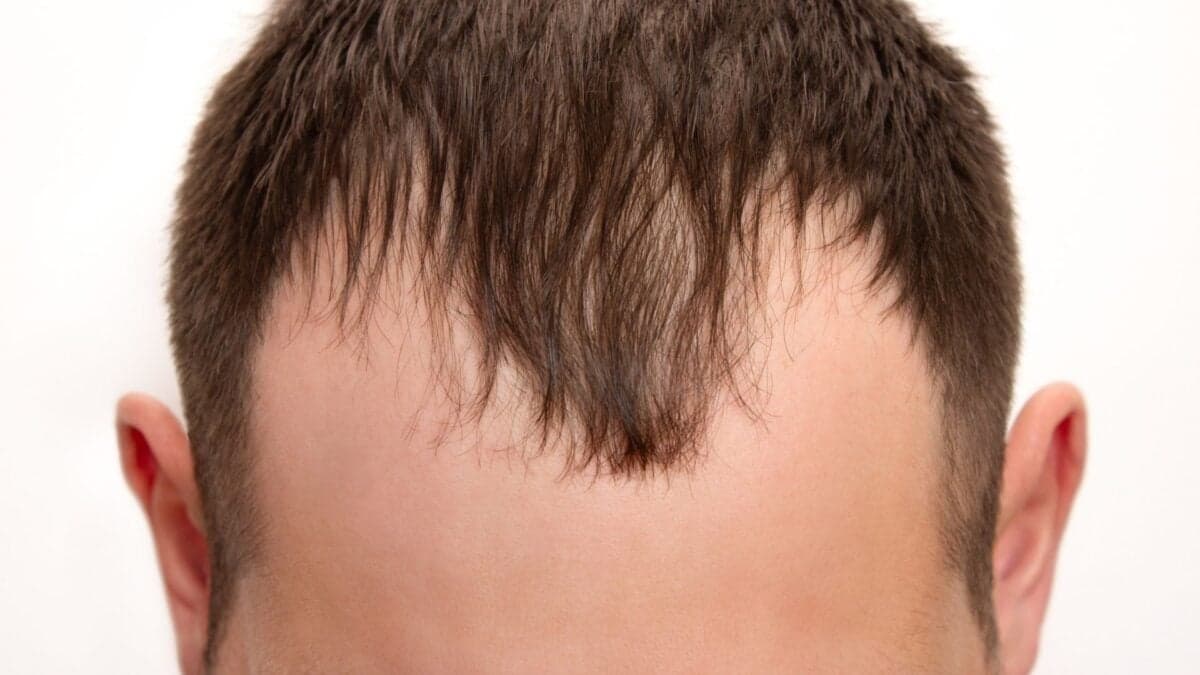 Balding Men Haven’t Had a New Pill Since the 1990s. That’s About to Change
